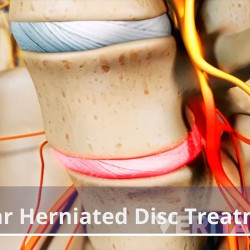 Disc Prolapse Treatment